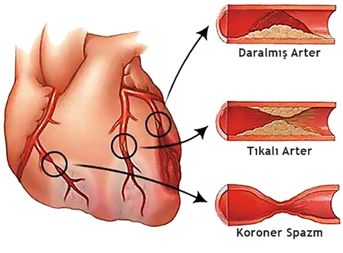 Koroner kalp hastalığı - Sermaye Kardiyoloji Associates